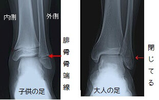 腓骨骨端線離開レントゲン